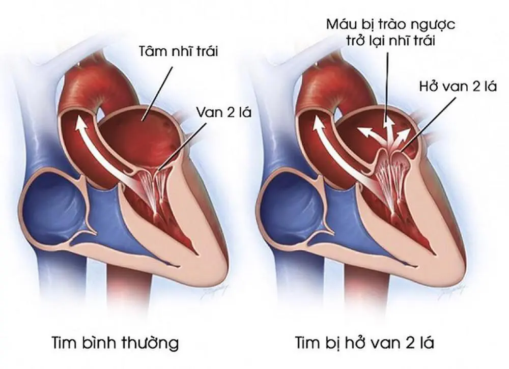 Hở van tim 2 lá khiến máu trào ngược lại tâm nhĩ trái.webp